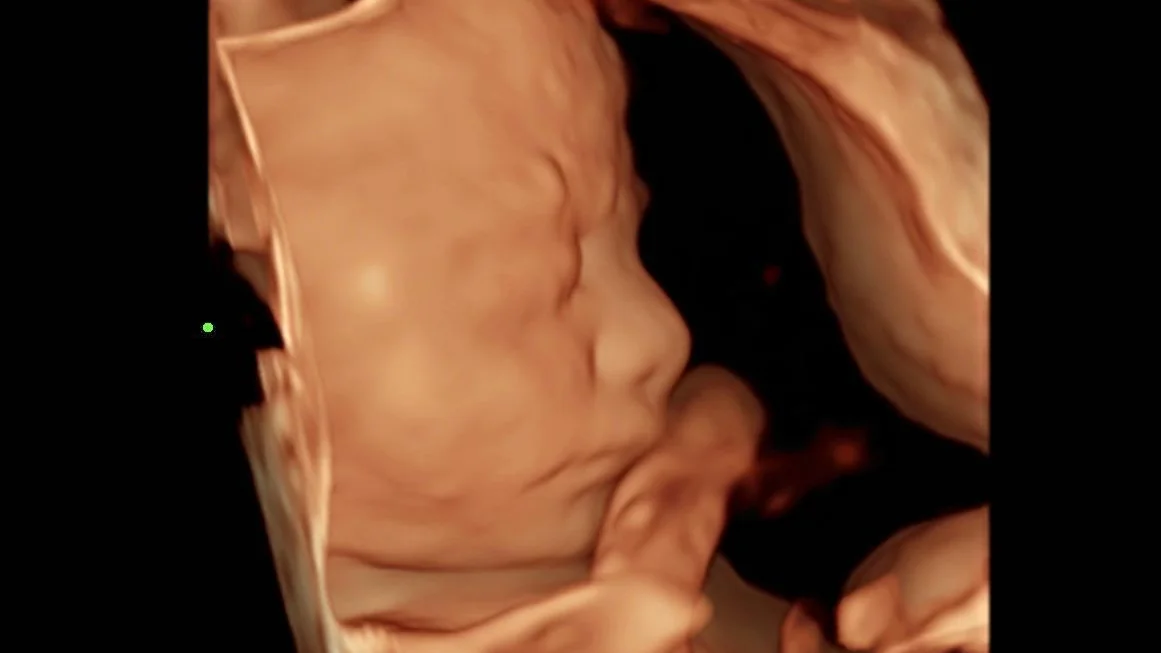 4 Boyutlu Ultrasonografi