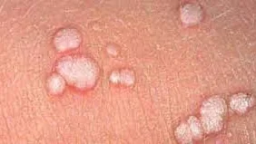 HPV Enfeksiyonu ve Smear Testi