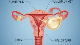 Ovarian Kist Ameliyatı