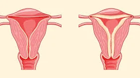 Rahim Kalınlaşması ve Endometrial Hiperplazi